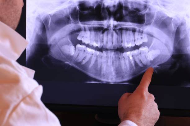 Best Emergency Wisdom Teeth Removal in Willoughby, OH